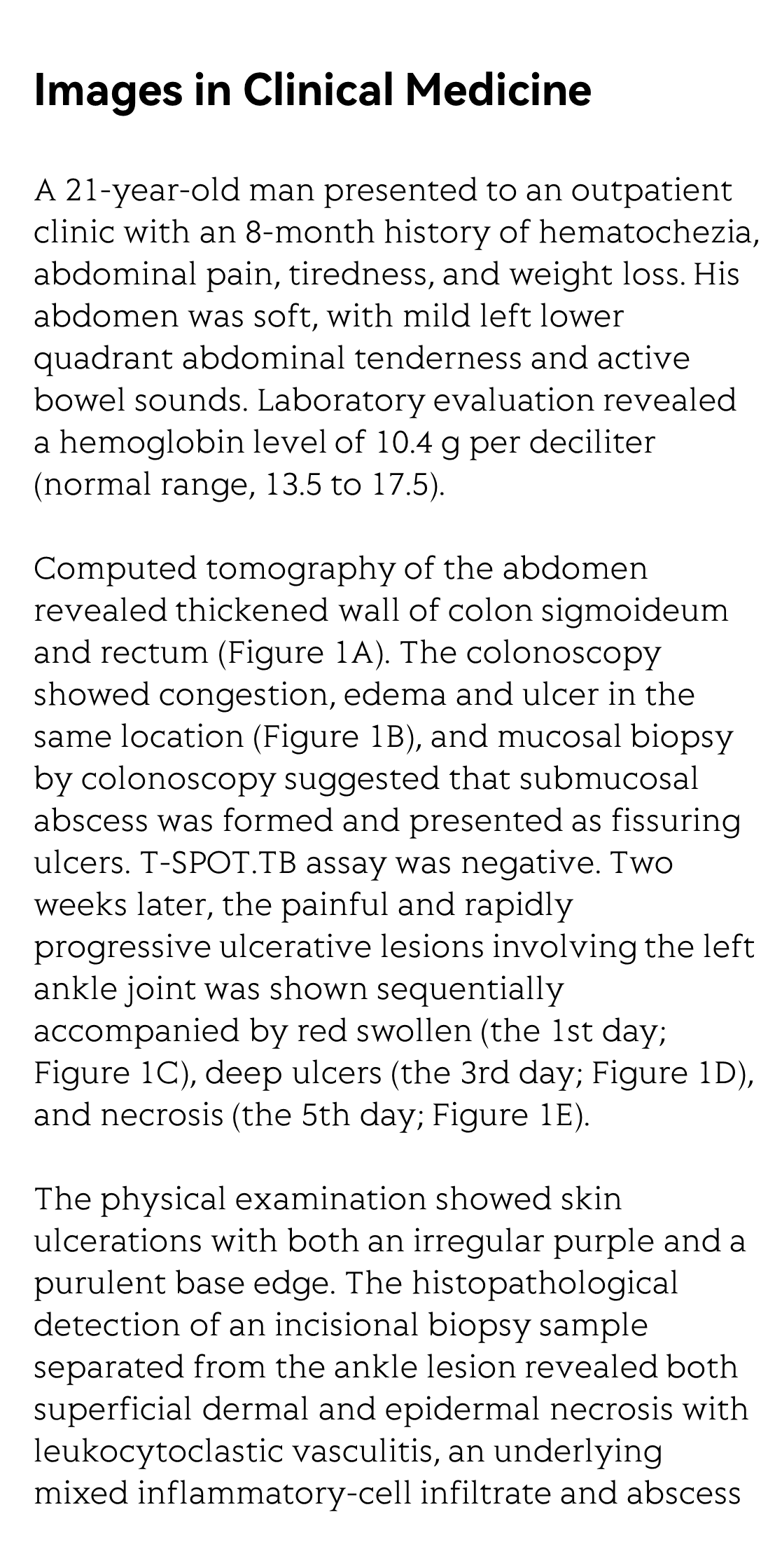 Pyoderma gangrenosum in ulcerative colitis_2