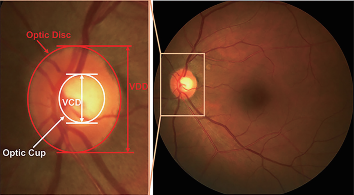 A narrative review of glaucoma screening from fundus images_4