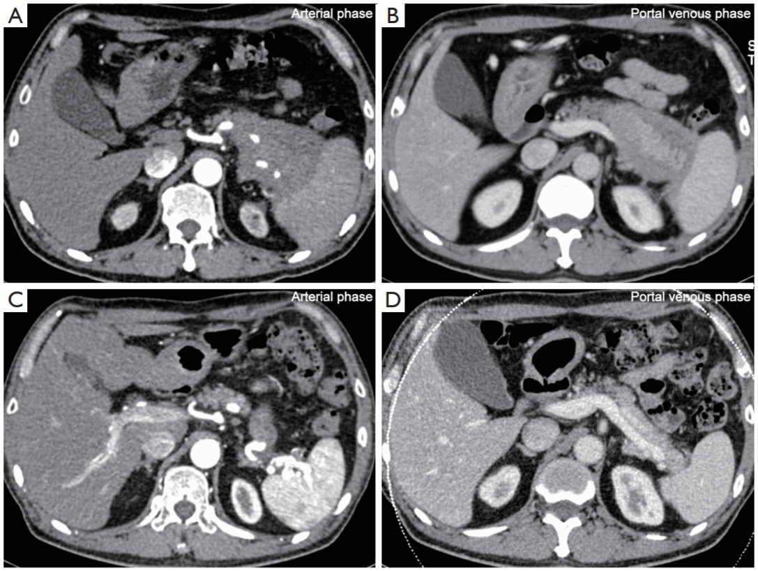 Peripancreatic vascular involvement in patients with type 1 autoimmune pancreatitis_4