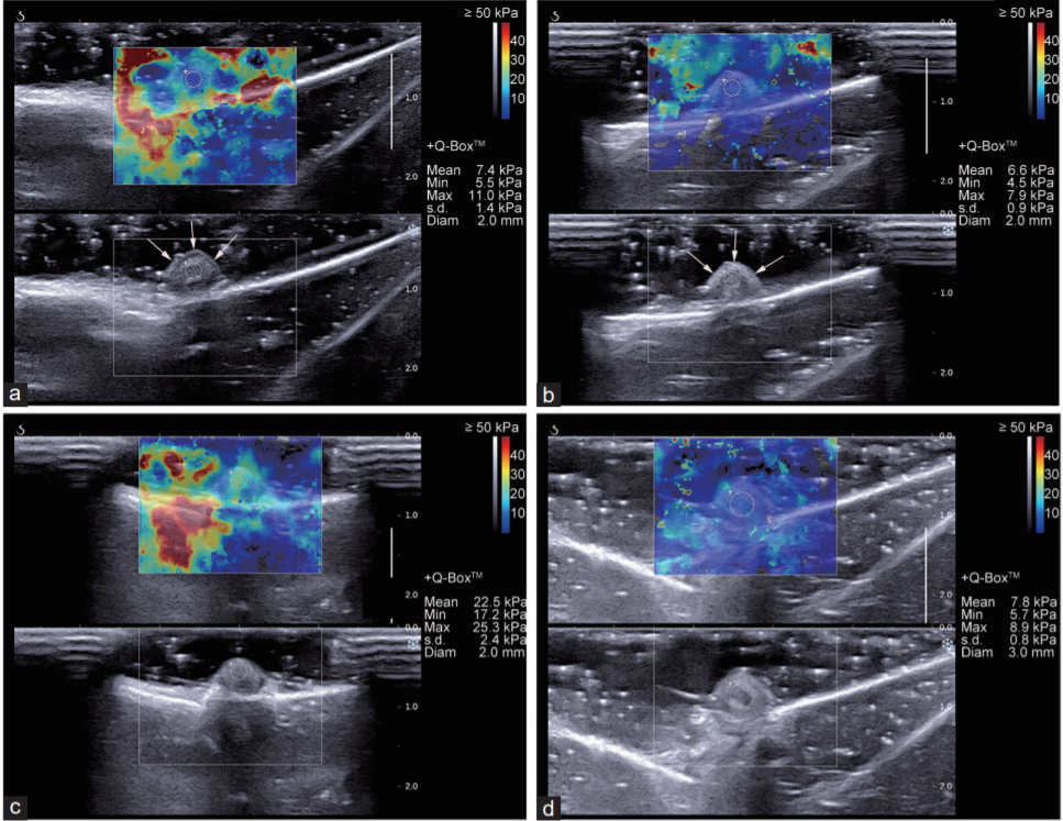 Experimental investigation of early assessment of corpora cavernosa fibrosis with two-dimensional shear wave elastography_4