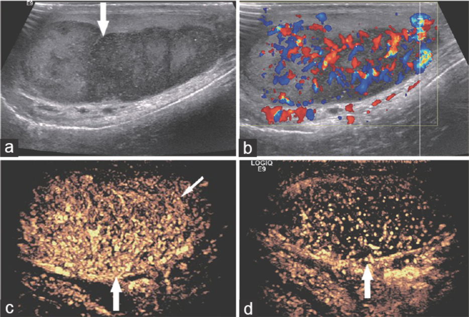 Contrast-enhanced ultrasound as a valuable imaging modality for characterizing testicular lesions_4