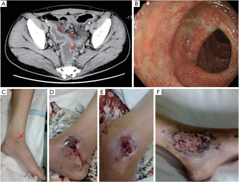 Pyoderma gangrenosum in ulcerative colitis_4