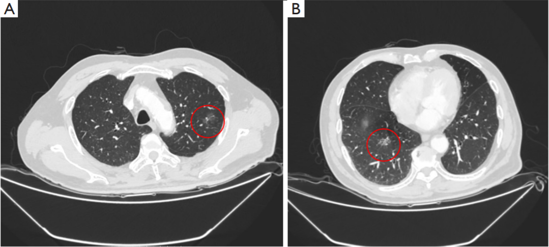 Electromagnetic bronchoscopy guided microwave ablation for early stage lung cancer presenting as ground glass nodule_4