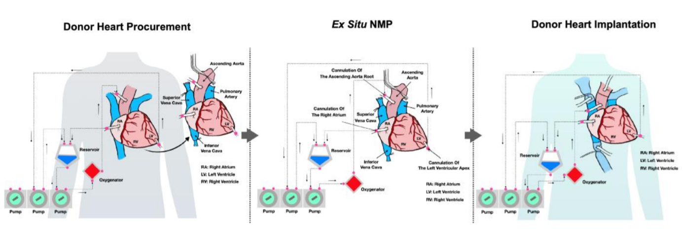 Transplantation of a Beating Heart: A First in Human_3