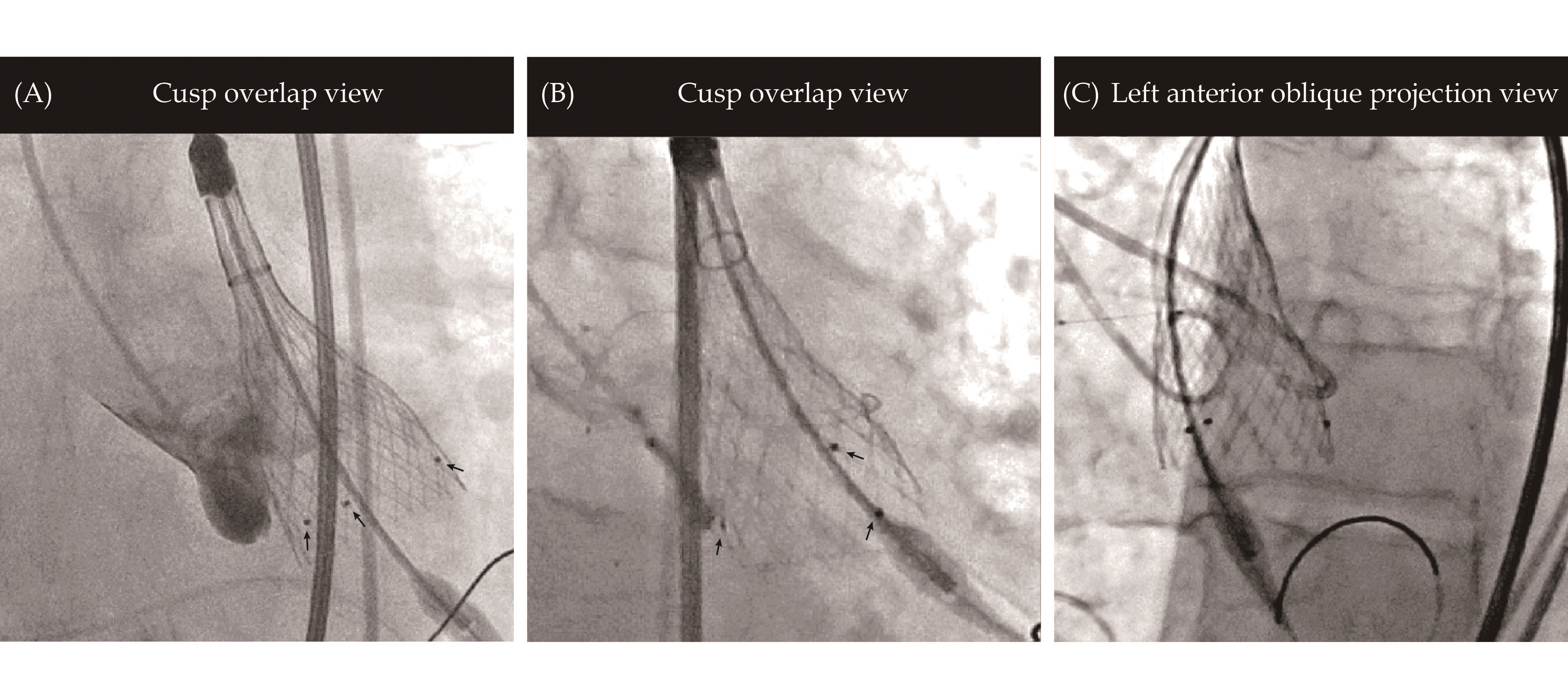 The incidence and predictors of high-degree atrioventricular block in patients with bicuspid aortic valve receiving self-expandable transcatheter aortic valve implantation_4